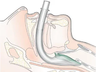 Intersurgical Maska nadkrtaniowa i-gel Innowacyjna maska do stosowania w anestezjologii i resuscytacji i-gel - Sprzęt ratunkowy - miniaturka - grafika 5