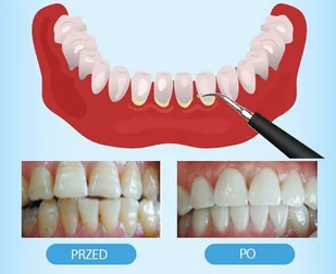 Braders Elektryczny Skaler Soniczny Usuwa kamień nazębny - Pozostałe urządzenia kosmetyczne - miniaturka - grafika 5