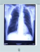 Meble i wyposażenie gabinetów medycznych - Ultra-Viol Sp.j NGP-11 Ultra Slim LED negatoskop ścienny z ekranem 36x43cm LED NGP 11 ścienny - miniaturka - grafika 1