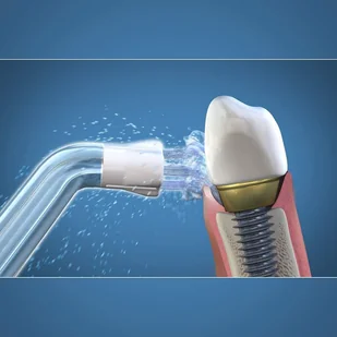 Waterpik WPS-2E końcówki do pielęgnacji implantów, mostów do IRYGATORA WF-05,06 - 2 szuki - Końcówki do irygatorów - miniaturka - grafika 3